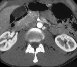 Prominent Gonadal Vein - CTisus CT Scan