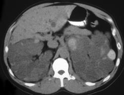 Polycystic Kidneys With Several Hemorrhagic Cysts - CTisus CT Scan