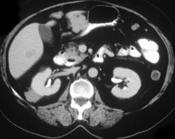 Implant on Kidney Due to Metastatic Melanoma - CTisus CT Scan