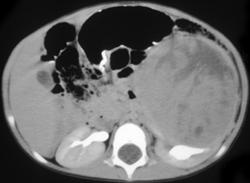 Wilms Tumor - CTisus CT Scan