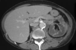 Infarcted Left Kidney Due to Occluded Left Renal Aa. - CTisus CT Scan