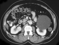 Right Sided Renal Cell Carcinoma - CTisus CT Scan