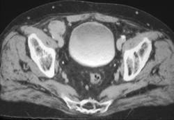 Undescended Right Testis - CTisus CT Scan