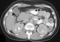 Transitional Cell Carcinoma of the Left Kidney - CTisus CT Scan