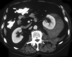 Renal Laceration - CTisus CT Scan