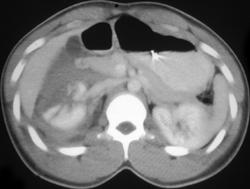 Renal Laceration - CTisus CT Scan