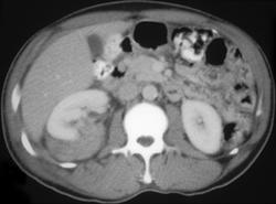 Renal Laceration - CTisus CT Scan