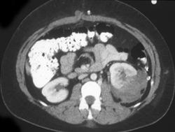 Renal Laceration - CTisus CT Scan