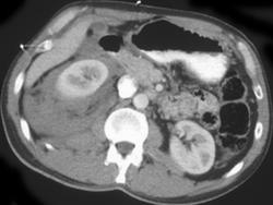 Renal Laceration - CTisus CT Scan