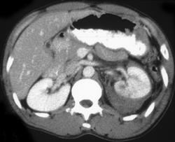 Renal Laceration - CTisus CT Scan