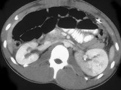 Acute Pyelonephritis - CTisus CT Scan