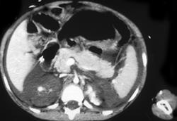 Infarcted Kidneys With Hypovolemia and Impending Shock Bowel - CTisus CT Scan