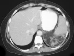 Large Left Renal Angiomyolipoma - CTisus CT Scan