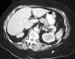 Tuberculosis (TB) of Left Kidney - CTisus CT Scan