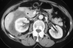 Renal Lymphoma - CTisus CT Scan