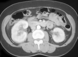 Acute Pyelonephritis - CTisus CT Scan