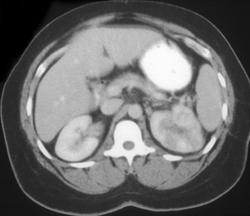 Acute Pyelonephritis - CTisus CT Scan