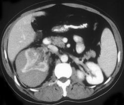 Acute Renal Bleed - CTisus CT Scan