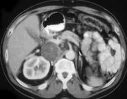 Adenopathy Due to Metastatic Left Renal Cell Carcinoma - CTisus CT Scan