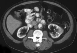 Renal Cell Carcinoma - CTisus CT Scan