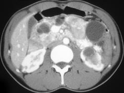 Renal Cell Carcinoma in Patient With Von Hippel-Lindau syndrome (VHL) - CTisus CT Scan