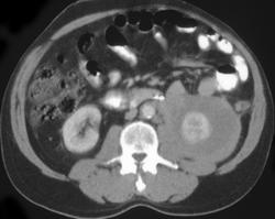 Renal Lymphoma - CTisus CT Scan