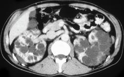 Polycystic Renal Disease - CTisus CT Scan