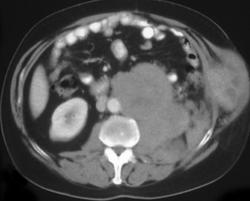 Renal Lymphoma - CTisus CT Scan