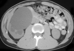 Right Ureteropelvic Junction (UPJ) - CTisus CT Scan