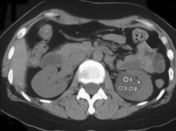 Renal Cyst - CTisus CT Scan