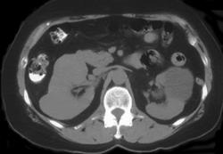 Renal Cyst and Renal Cancer - CTisus CT Scan