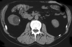 Renal Cyst - CTisus CT Scan