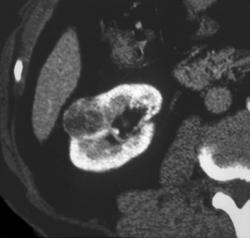 Cystic Renal Carcinoma - CTisus CT Scan