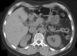 Renal Cell Carcinoma - CTisus CT Scan