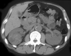 Vascular Renal Cell Carcinoma - CTisus CT Scan