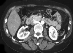 Vascular Renal Cell Carcinoma - CTisus CT Scan