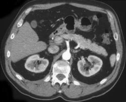 Right Renal Cell Carcinoma - CTisus CT Scan