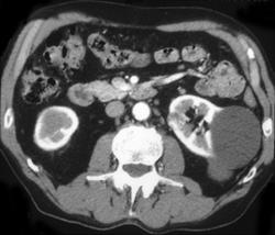 Small Left Renal Cell Carcinoma and Renal Cysts - CTisus CT Scan