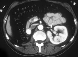 Renal Cell Carcinoma in Left Kidney - CTisus CT Scan