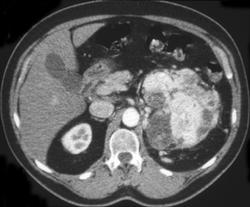 Hypervascular Renal Cell Carcinoma - CTisus CT Scan