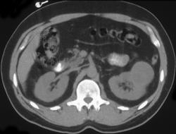 Renal Cell Carcinoma - CTisus CT Scan