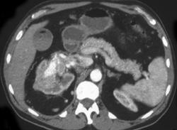 Transitional Cell Cancer (TCC) of Kidney Invades Renal Vein - CTisus CT Scan