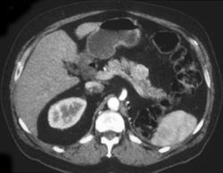 Post Left Nephrectomy (renal Cancer) With Metastases to Pancreas - CTisus CT Scan