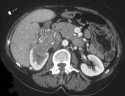 Renal Cell Cancer Invades Inferior Vena Cava (IVC) - CTisus CT Scan