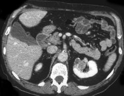 Renal Cell Carcinoma - CTisus CT Scan