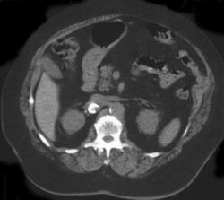 Renal Artery Aneurysm - CTisus CT Scan