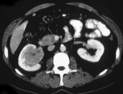 Transitional Cell Cancer (TCC) of the Kidney - CTisus CT Scan