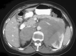 Renal Lymphoma - CTisus CT Scan