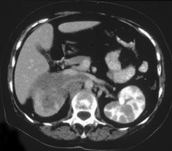 Renal Lymphoma - CTisus CT Scan