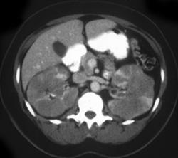 Renal Lymphoma - CTisus CT Scan